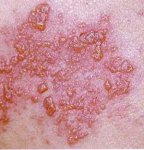 herpes zoster day 6. lesions joining other lesions.