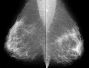 mammo breast CA